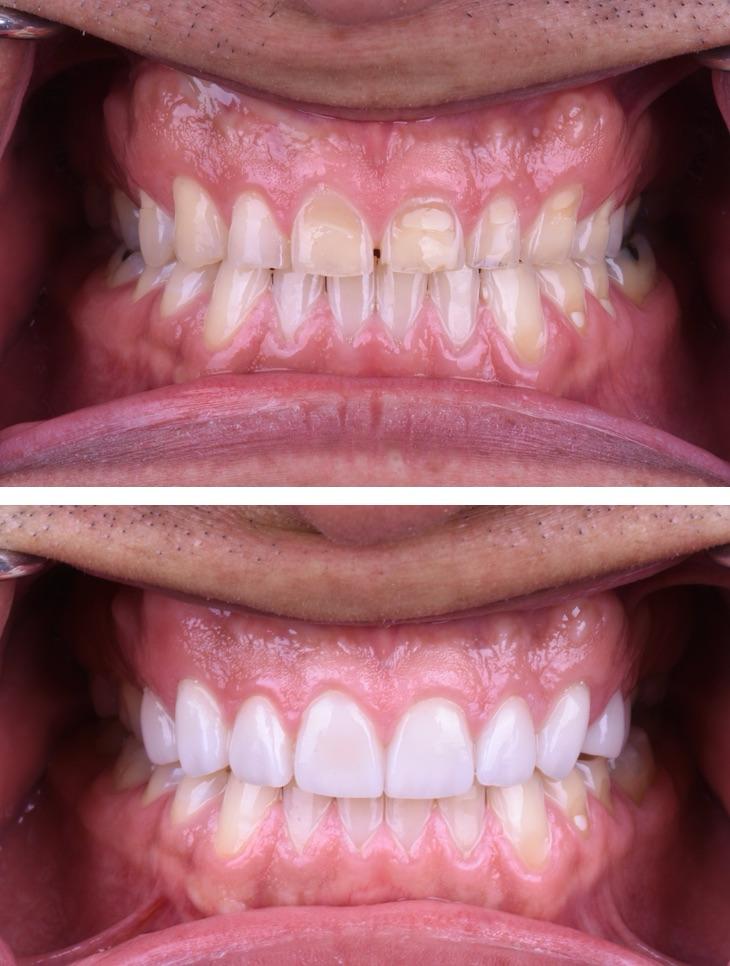 Tratamiento dental - Antes y Después